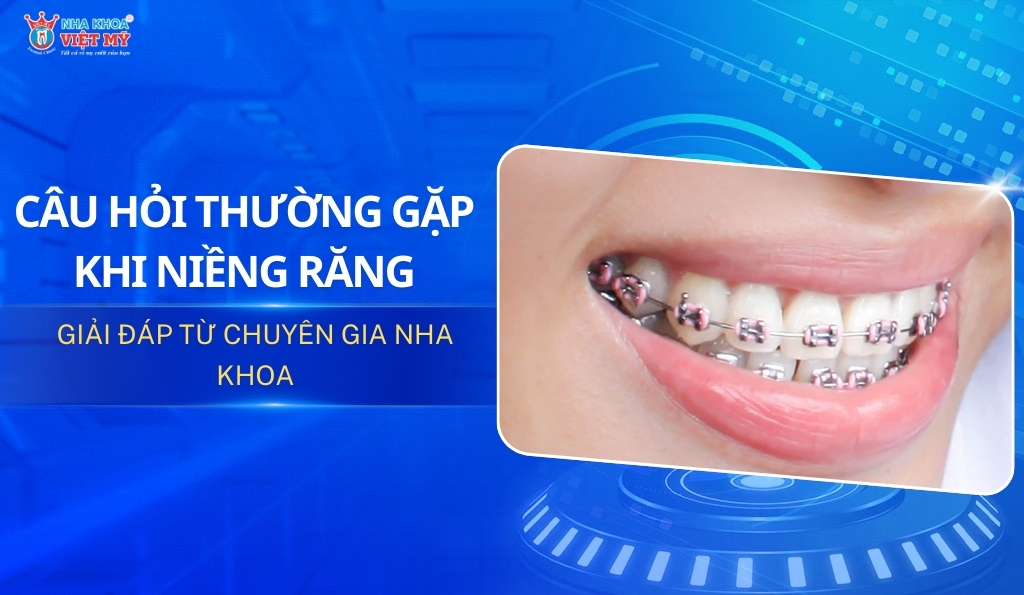 thumbnail những câu hỏi thường gặp khi niềng răng