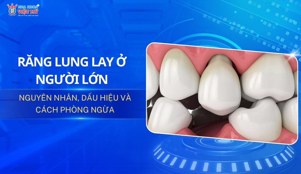 thumbnail răng lung lay ở người lớn