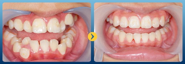 Những điều cần biết trước khi điều trị chỉnh nha – niềng răng