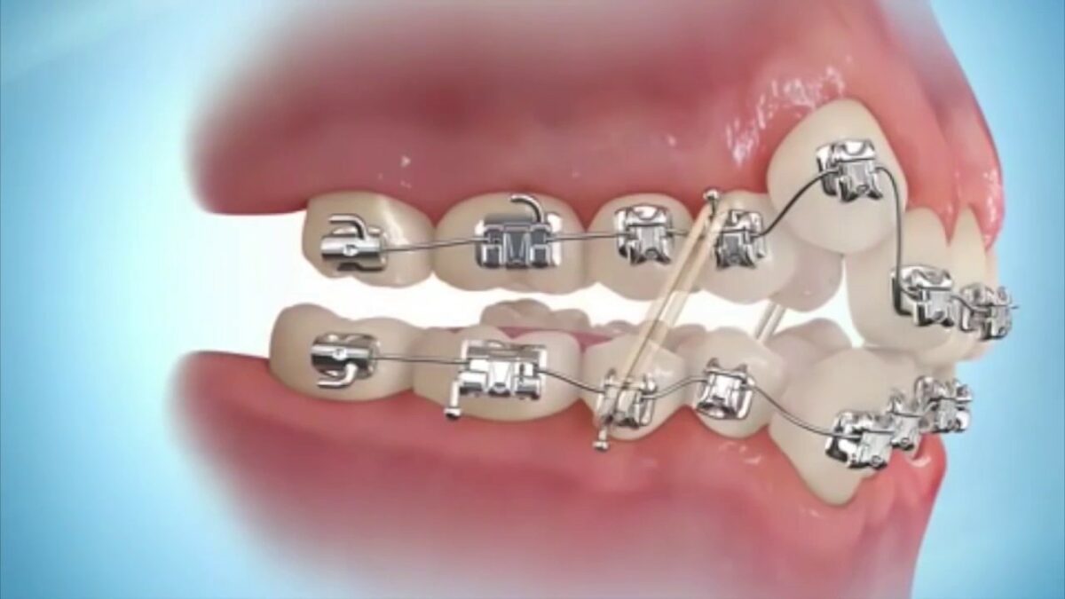 Những điều cần biết trước chỉnh nha – niềng răng