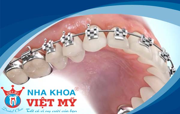 chỉnh nha tại Tuy Hòa