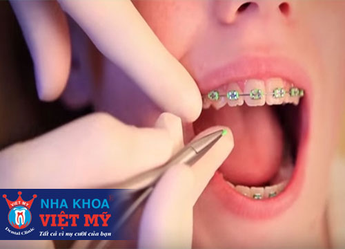 nha khoa niềng răng rẻ nhất tại Kiên Giang