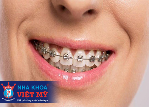 Niềng răng - Bí quyết để có hàm răng thẳng đều, nụ cười hoàn mỹ