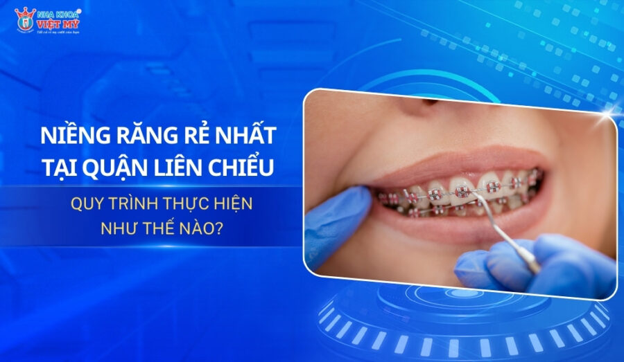 thumbnail niềng răng rẻ nhất tại quận Liên Chiểu