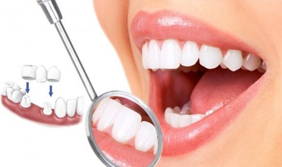 bọc răng sứ giúp mang lại vẻ đẹp cho hàm răng