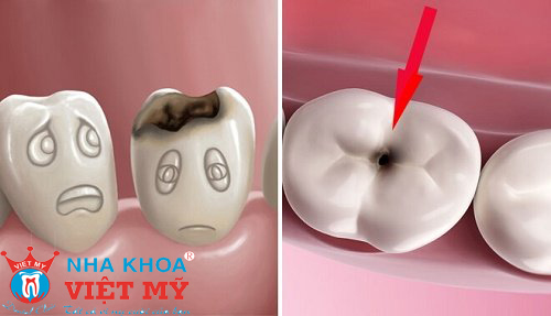 răng có vấn đề trước khi bọc sứ