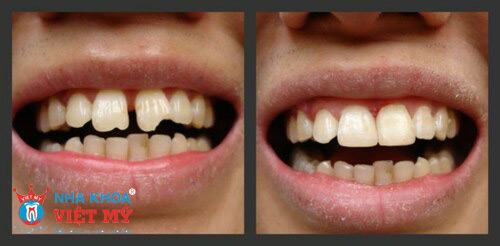 kiểm tra những thay đổi của răng sau khi bọc răng sứ