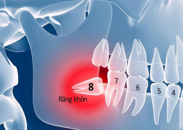 răng khôn là gì