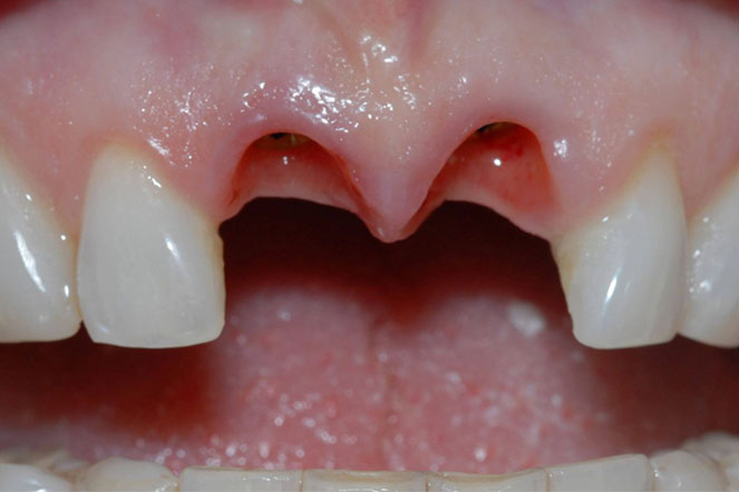 hậu quả của mất răng