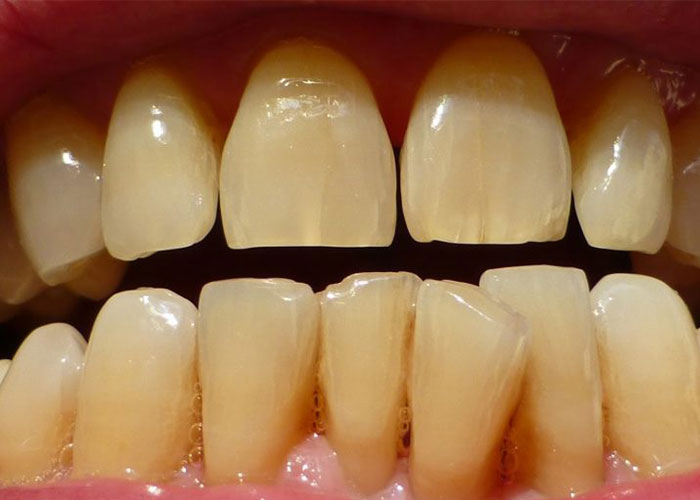 răng bị ố vàng