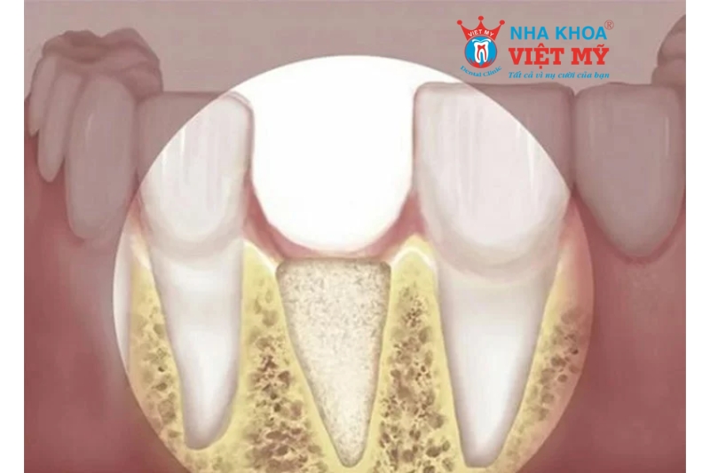 Mất răng dẫn đến tiêu xương hàm