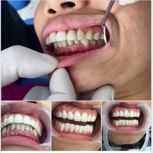 Cách phân biệt giữa hô răng và hô hàm, phương pháp điều trị