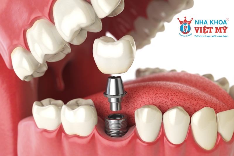 implant giúp khắc phục hậu quả của việc mất răng