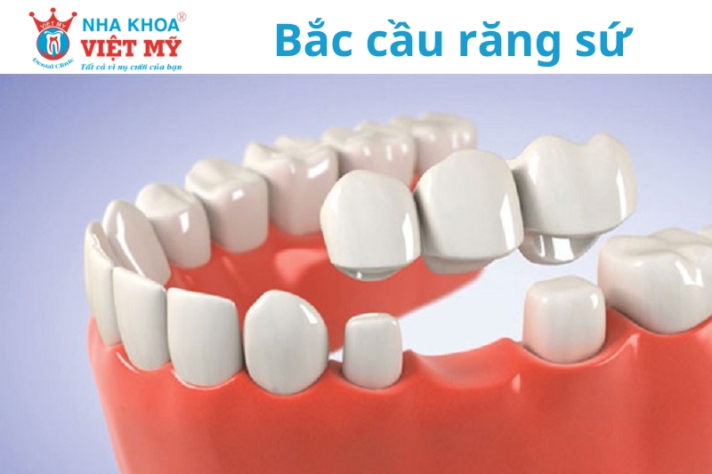 người cao tuổi làm được trồng răng bắc cầu răng sứ