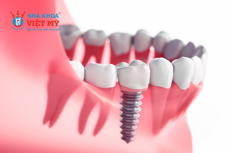 trồng răng implant cho người cao tuổi