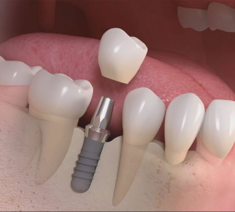 phuong phap trong rang implant