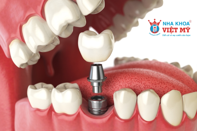 phương pháp implant cho người trồng răng bị mất lâu năm