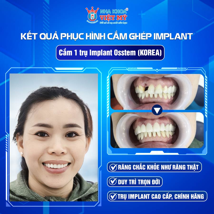 Ket-qua-phuc-hinh-cam-ghep-Implant