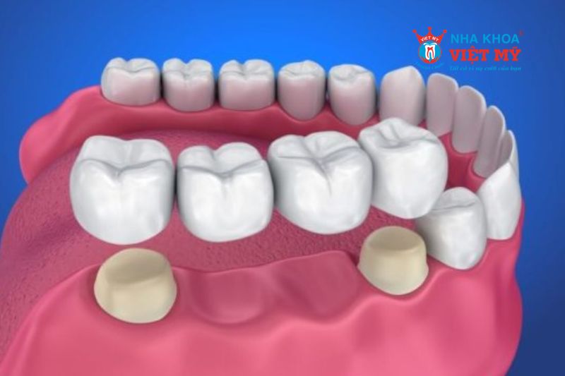 Làm cầu răng sứ là một trong quy trình bọc răng sứ