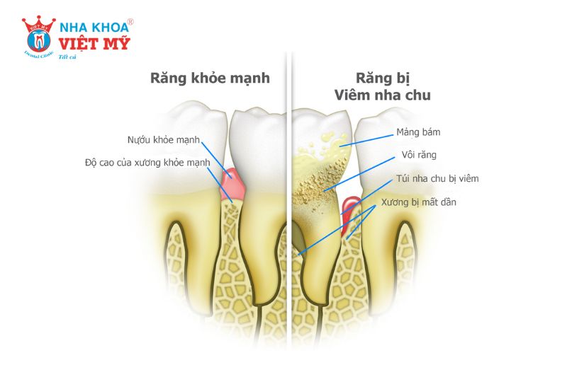 Bệnh lý về răng là một trong những nguyên nhân bọc răng sứ bị đau