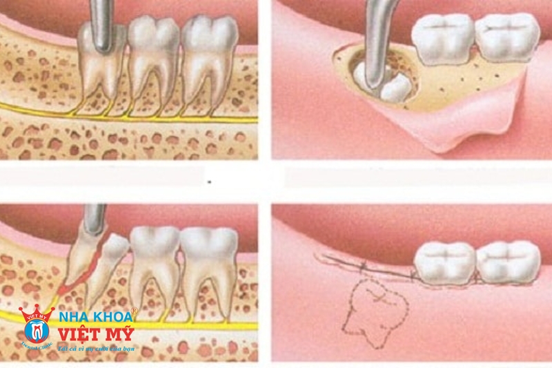 quy trình nhổ răng số 8 chuẩn y khoa