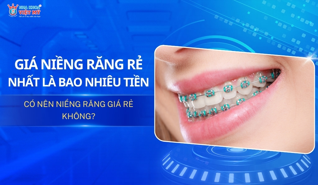 thumbnail giá niềng răng rẻ nhất bao nhiêu tiền