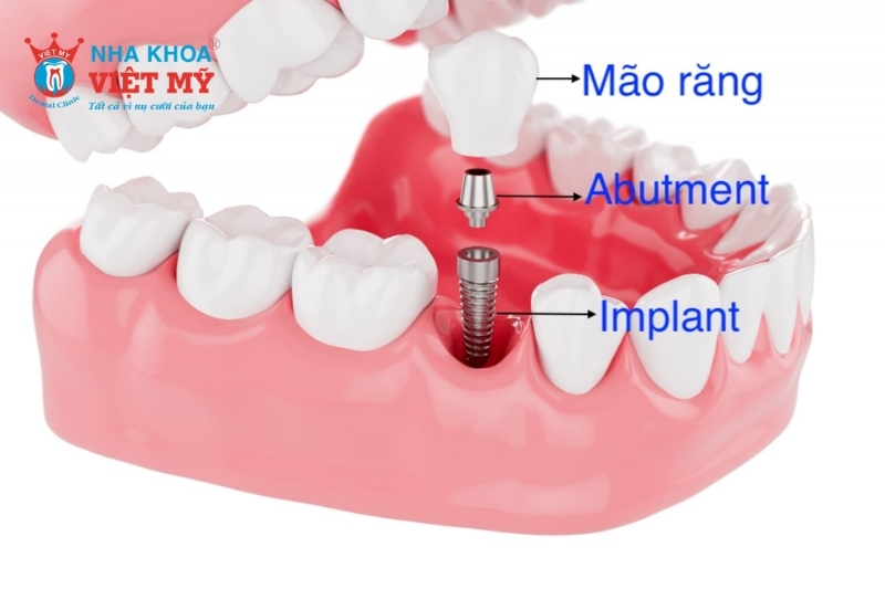 cấu tạo của trồng răng implant gồm 3 thành phần cơ bản