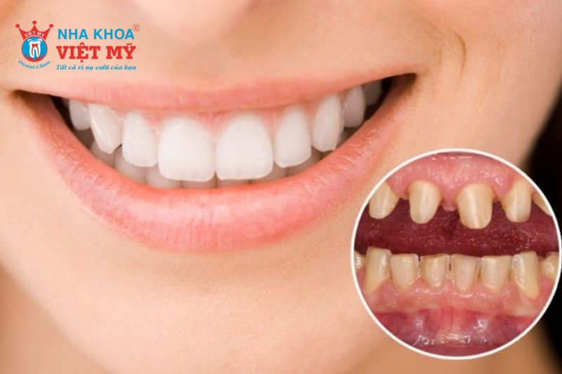 Các yếu tố ảnh hưởng đến độ bền của bọc răng sứ