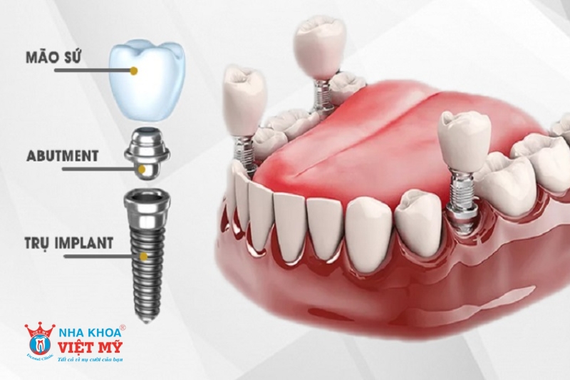 chất lượng trụ implant và răng sứ