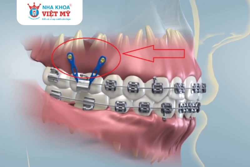 giai đoạn đóng khoảng trong niềng răng