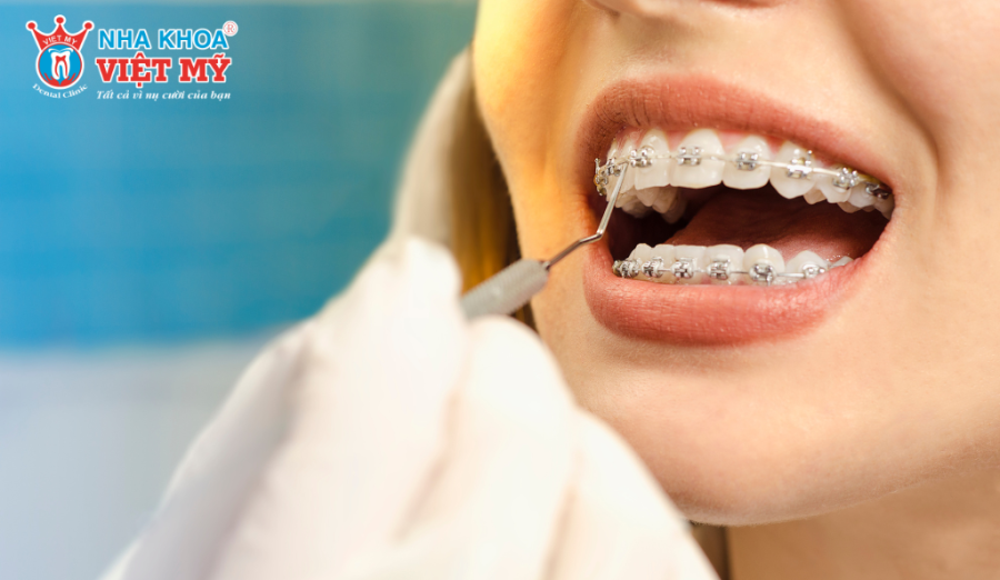 Giai đoạn dàn đều răng giúp răng sắp xếp thẳng hàng hơn trên cung hàm