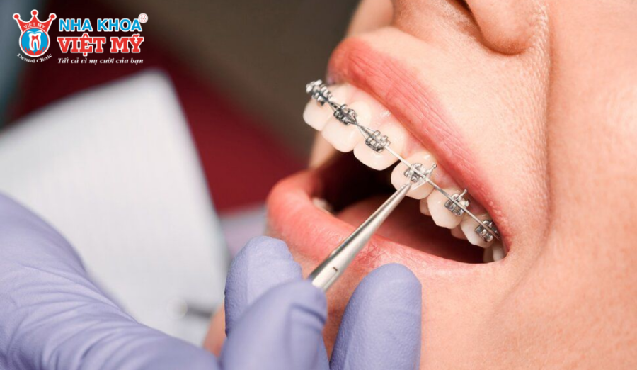 Chỉnh khớp cắn giúp răng ăn khớp đều và nhai hiệu quả hơn