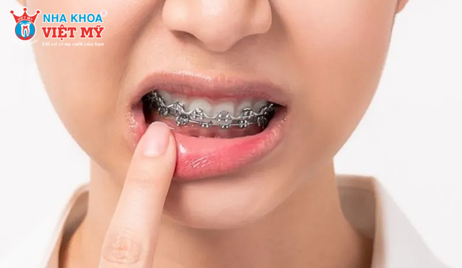 Thời điểm gắn mắc cài và những lần điều chỉnh lực là giai đoạn niềng răng đau nhất