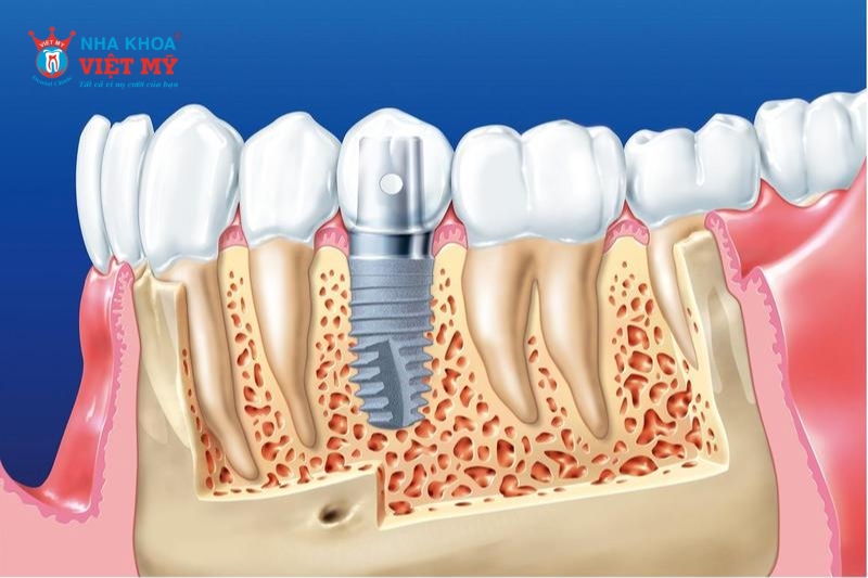 kỹ thuật trồng răng implant