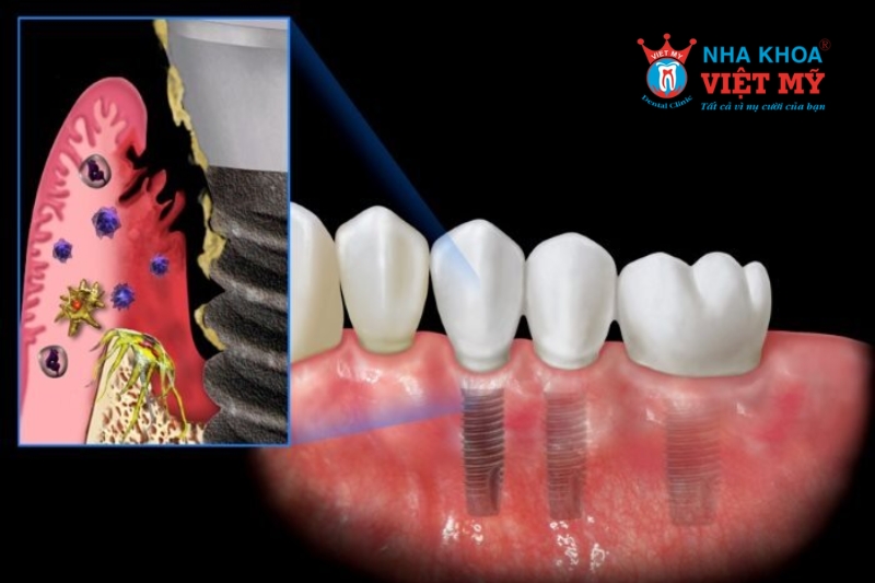 trồng răng implant có đau không do nhiễm trùng