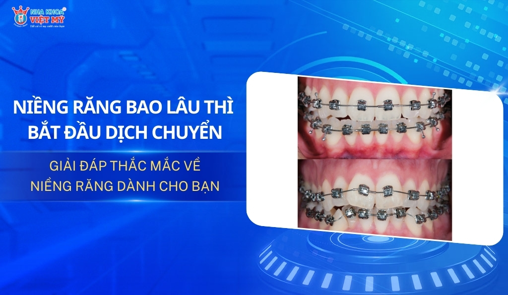 thumbnail niềng răng bao lâu thì bắt đầu dịch chuyển