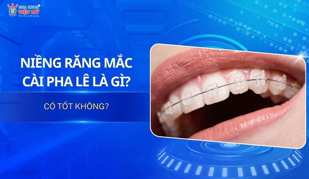 thumbnail niềng răng mắc cài pha lê là gì