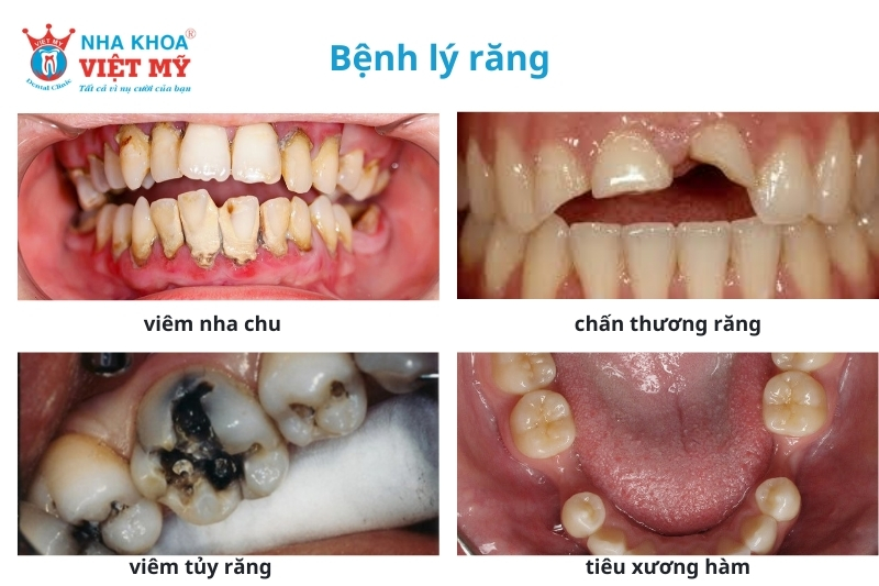 răng sứ bị lung lay do bệnh lý