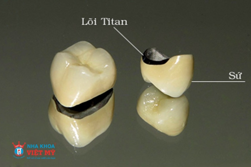 loại răng sứ titan margin