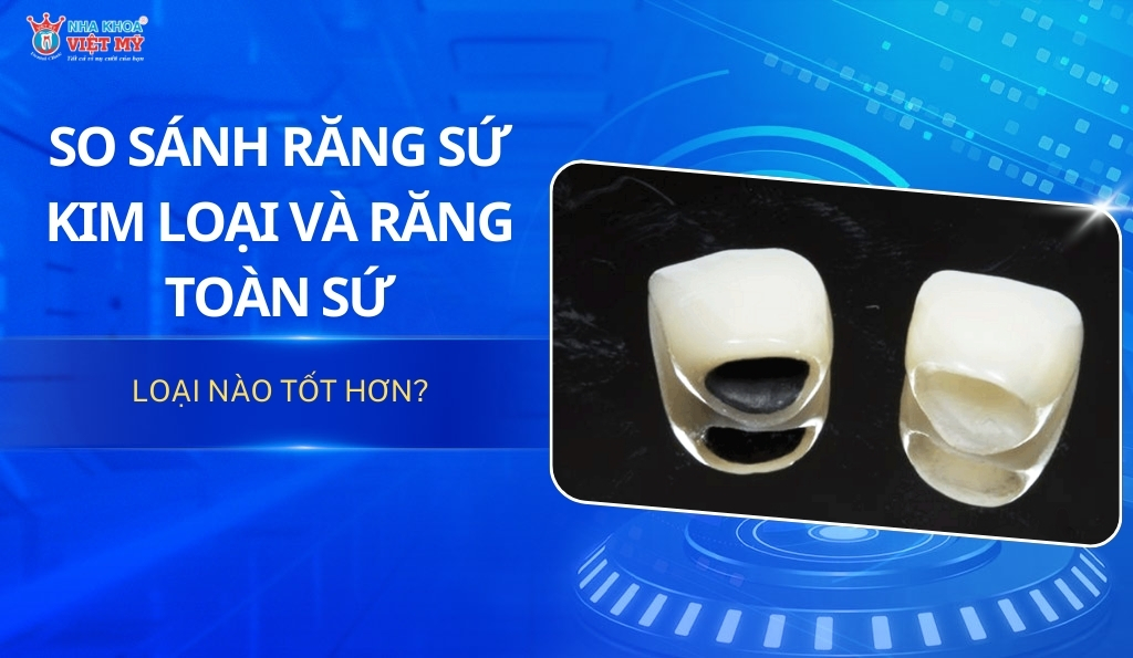 thumbnail so sánh răng sứ kim loại và toàn sứ