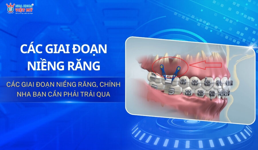 các giai đoạn niềng răng thumbnail