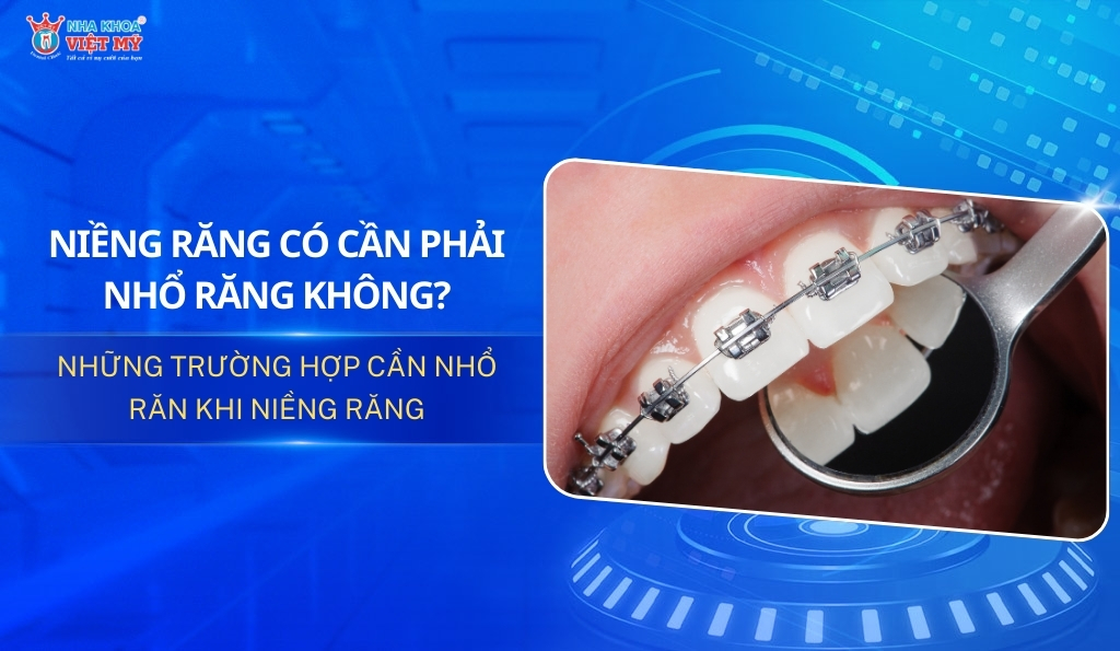 thumbnail niềng răng có phải nhổ răng không