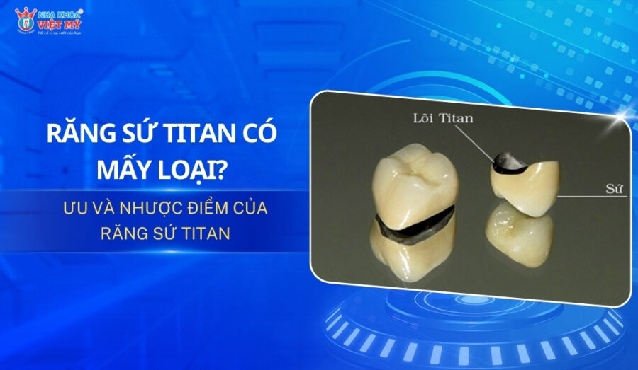 răng sứ titan có mấy loại thumbnail