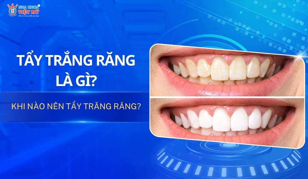 thumbnail tẩy trắng răng là gì