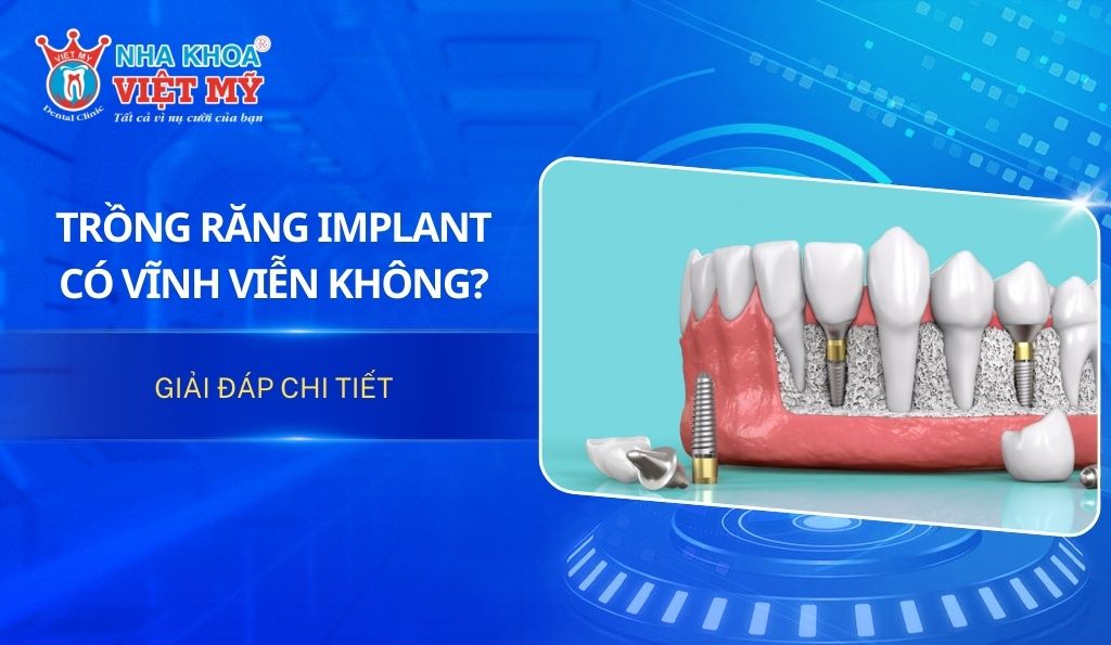 Trồng răng Implant có vĩnh viễn không?