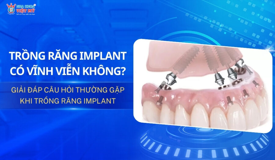 trồng răng implant có vĩnh viễn không thumbnail