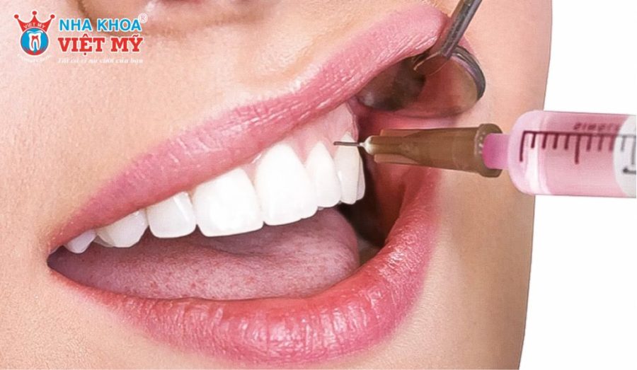 Trước khi tiến hành, bác sĩ sẽ thực hiện gây tê cục bộ tại vùng cấy ghép