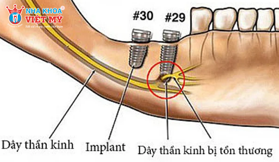 Tổn thương dây thần kinh là biến chứng nguy hiểm nhất