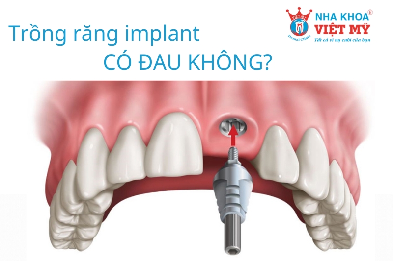 trồng răng implant có đau không kéo dài lâu thế nào