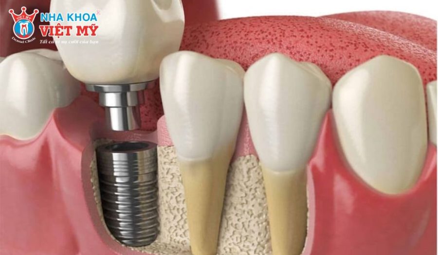 Chất lượng và mật độ xương hàm là nền tảng sinh học quyết định khả năng tích hợp trụ Implant và độ bền lâu dài sau cấy ghép